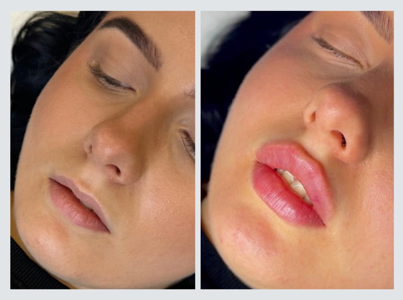 Före och efterbilder avseende läppförstoring